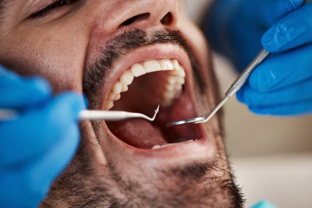 Best Emergency Tooth Extraction in Wilmer, TX